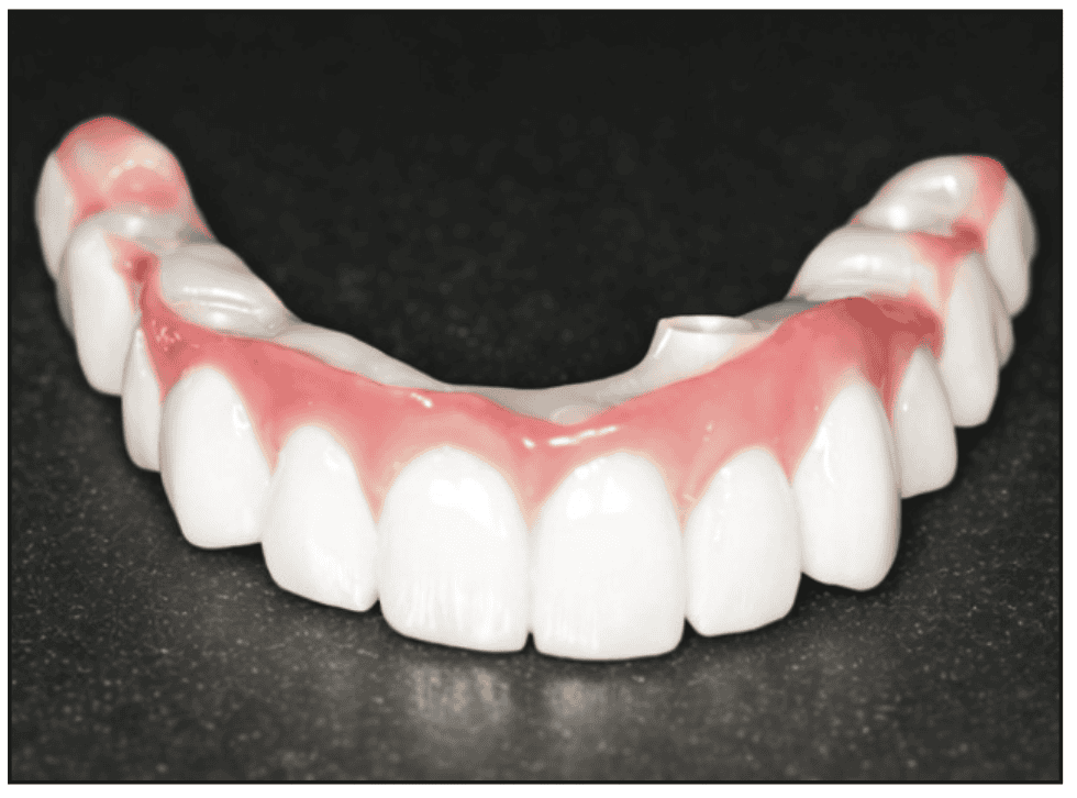 A Predictable Transition to a Screw-Retained Full-Arch Prosthesis