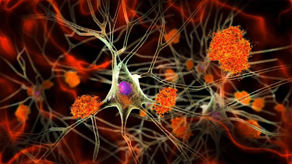 Alzheimer’s Signs Hidden in Midlife Brains, Study Shows A computer rendering of amyloid plaques between neurons and neurofibrillary tangles inside neurons.