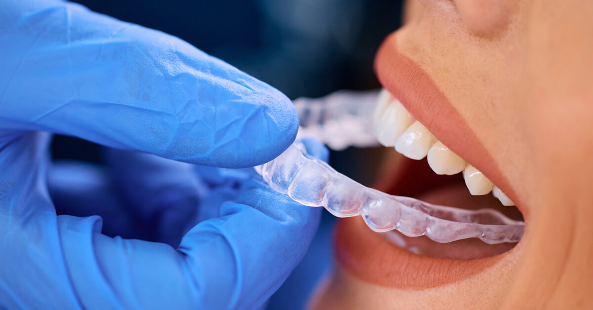 Danish study examines aligner treatment