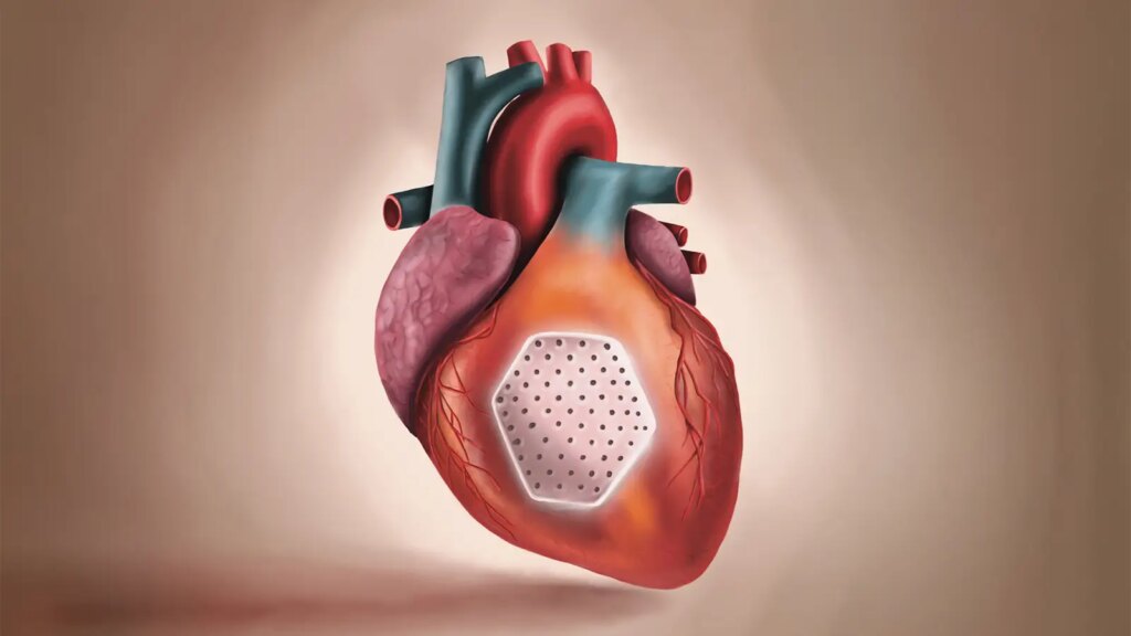 A computer rendering of a heart with a ventricular patch.
