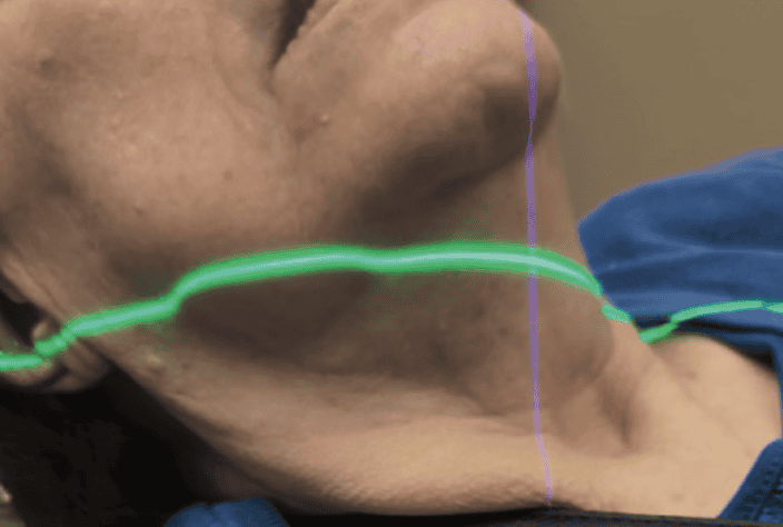 Low-Level Laser Therapy - Dentistry Today