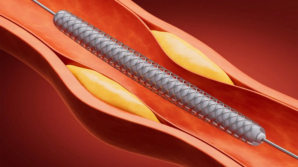 A computer rendering of the deployment of a balloon stent in an artery narrowed by plaque.
