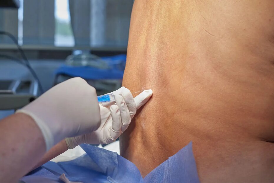 A photo of a senior man receiving an injection in his spine.