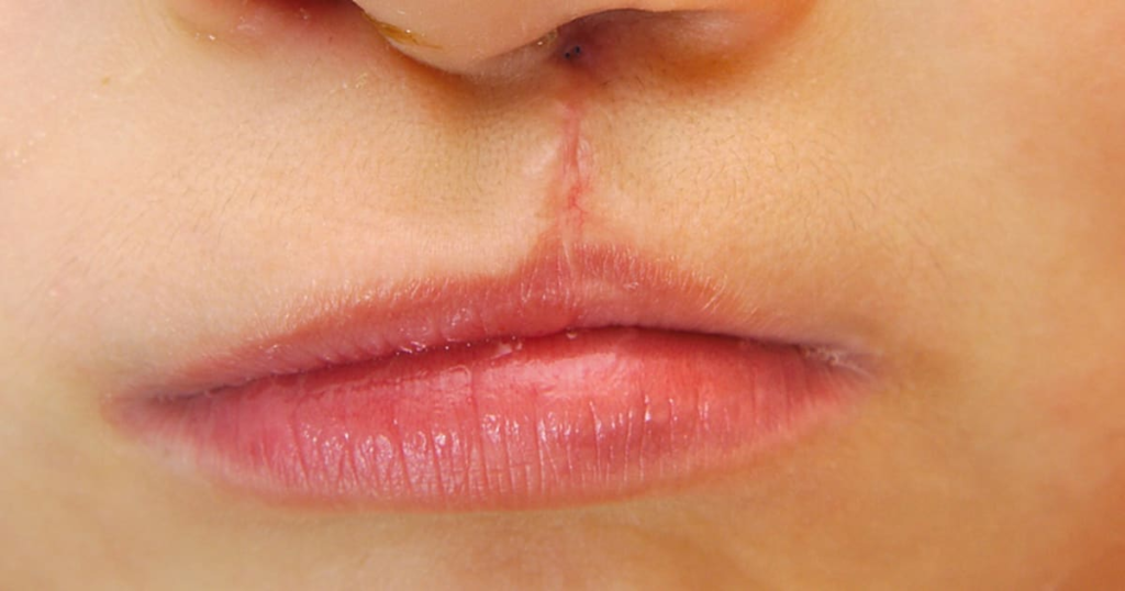 Action Needed for Dental Care Access for Cleft Patients Action Needed for Dental Care Access for Cleft Patients