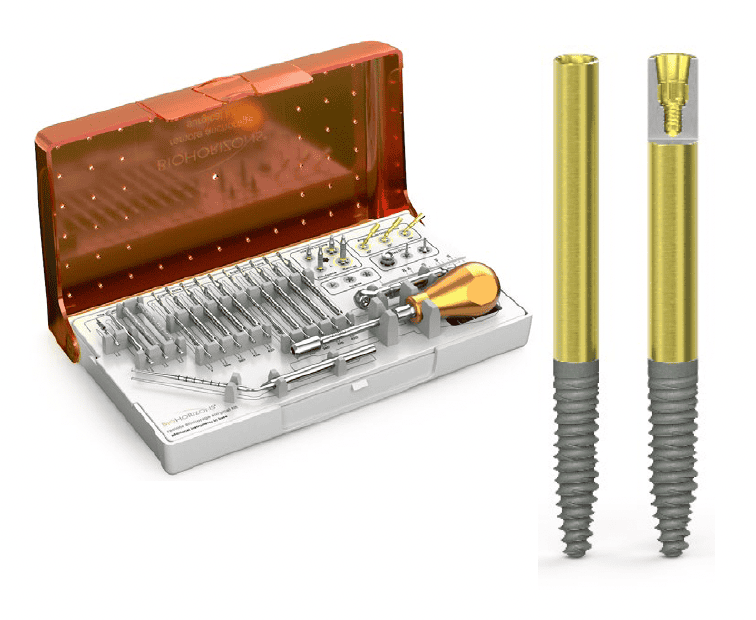 BioHorizons Launches Pro Zygoma Implant