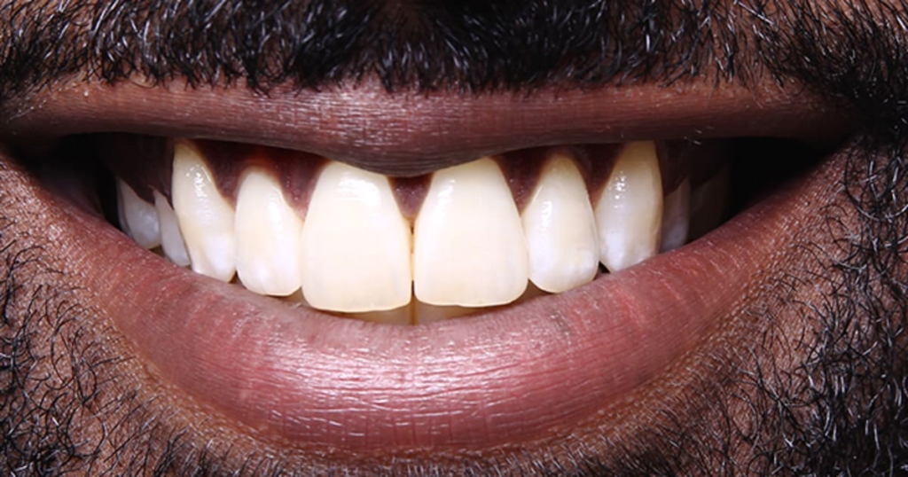 Brits Skip Brushing & Turn to AI for Dental Advice