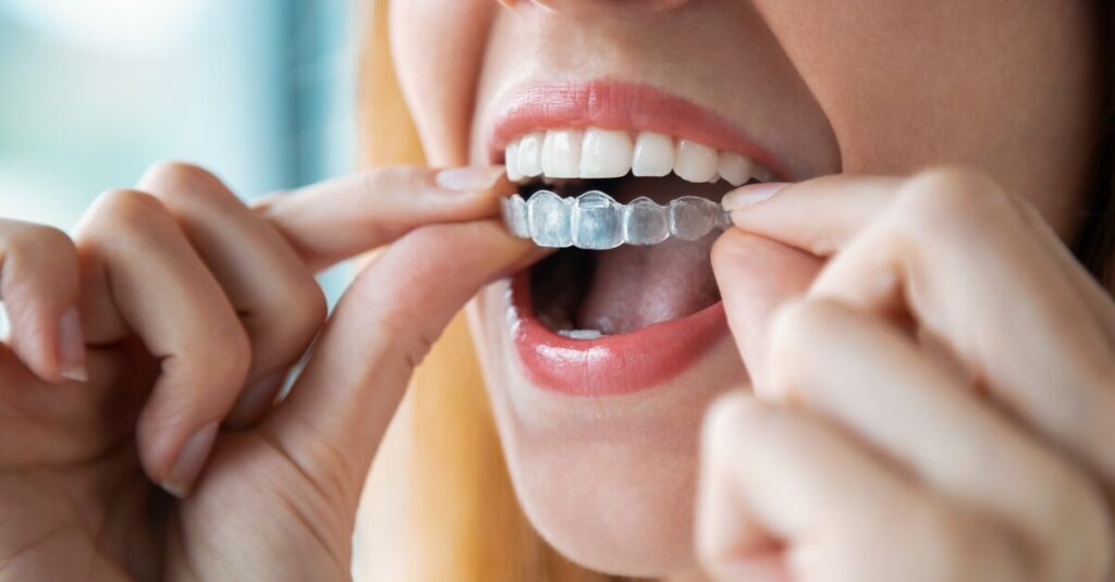 Digital tools advance aligner treatment planning Digital tools advance aligner treatment planning