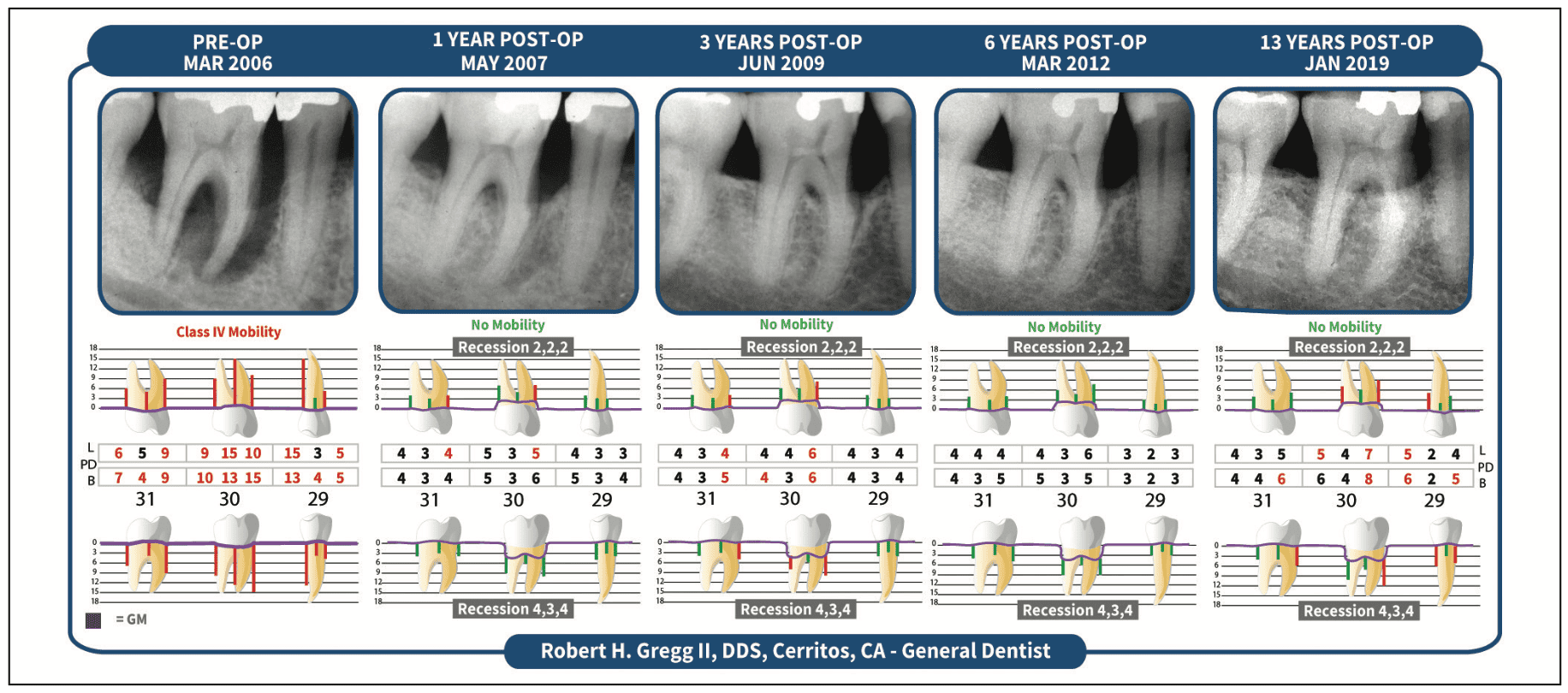 Setting a New Standard in Minimally Invasive Laser Dentistry