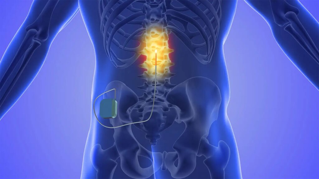 A computer rendering of cervical epidural spinal cord stimulation.