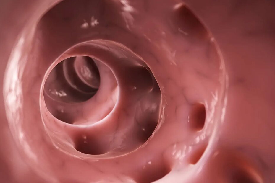 A computer rendering of diverticulitis.