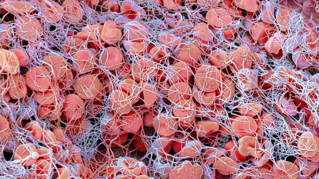 Tenecteplase Unseats Low-Dose Alteplase Favored for Asian Patients A scanning electron microscope image of red blood cells trapped in a fibrin mesh.