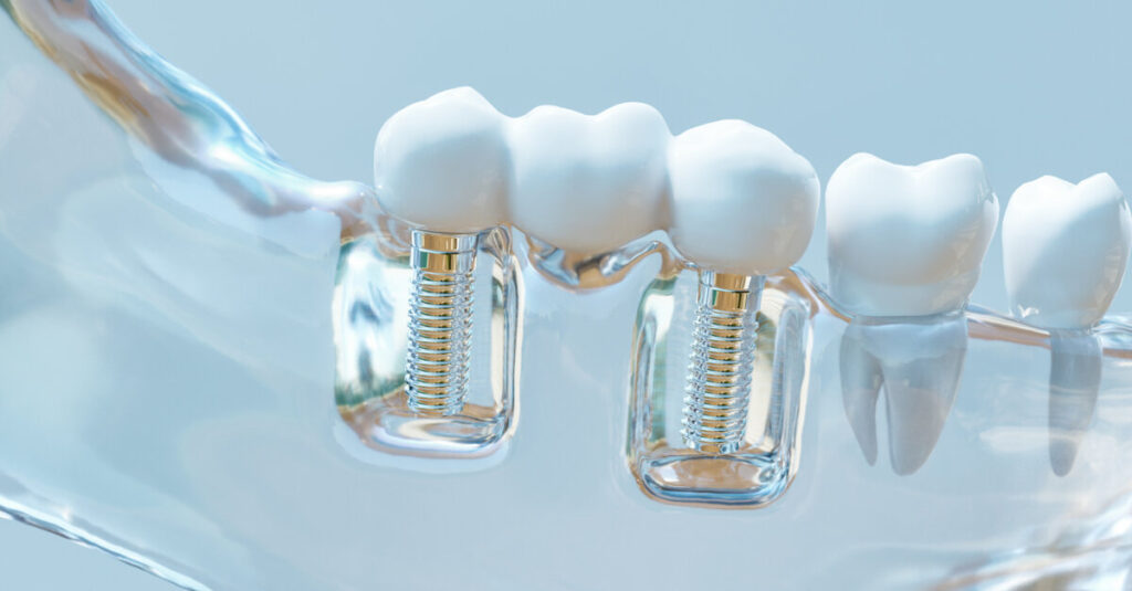 Titanium particles may drive peri-Implantitis Titanium particles may drive peri-Implantitis
