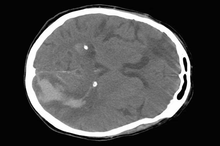A CT scan of a brain showing a stroke.