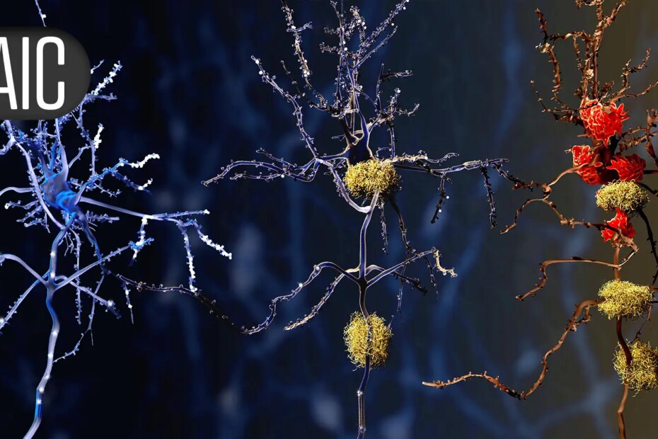 Alzheimer's Autopsy Study Raises Questions About Amyloid Clearance