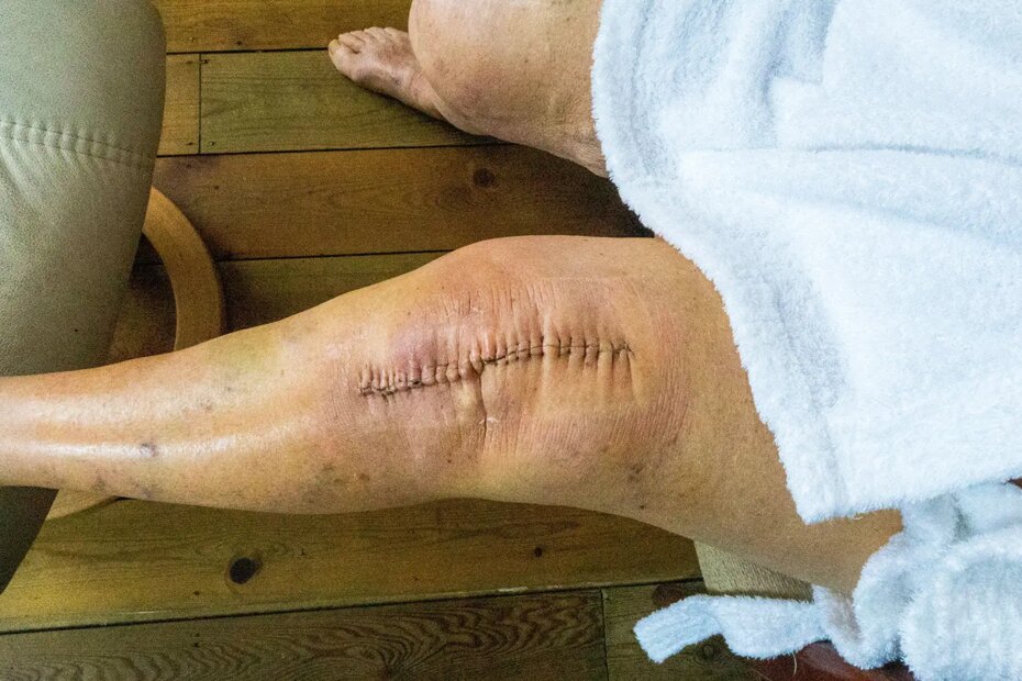 A photo of a woman with stitches in her left knee after arthroplasty.