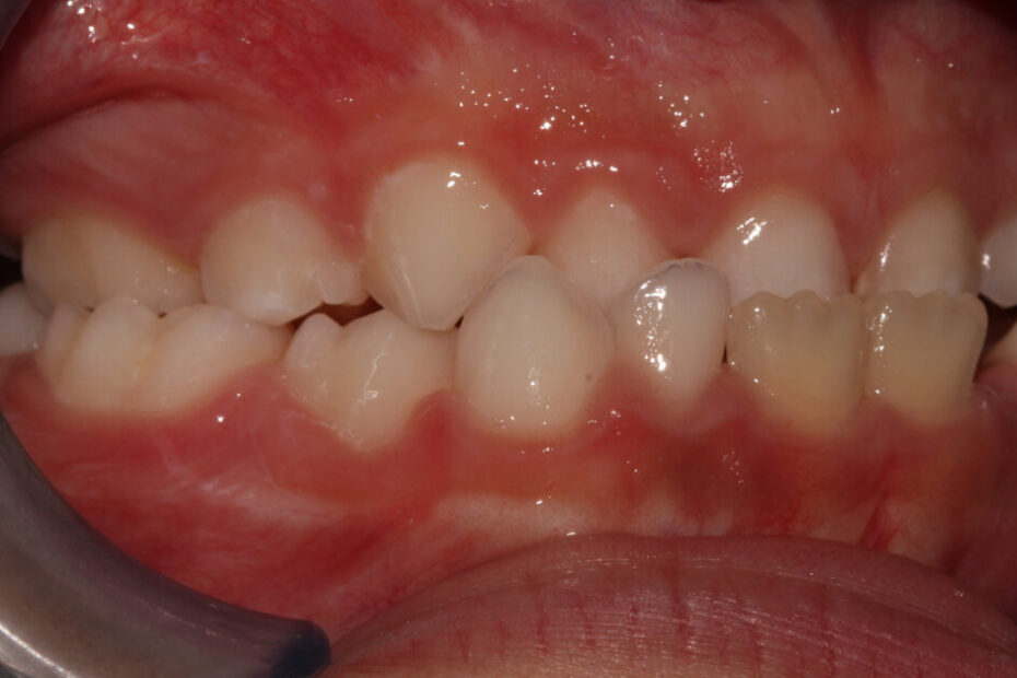 Dental News - Management of maxillary transverse deficiency in children using a newly designed arch conformer