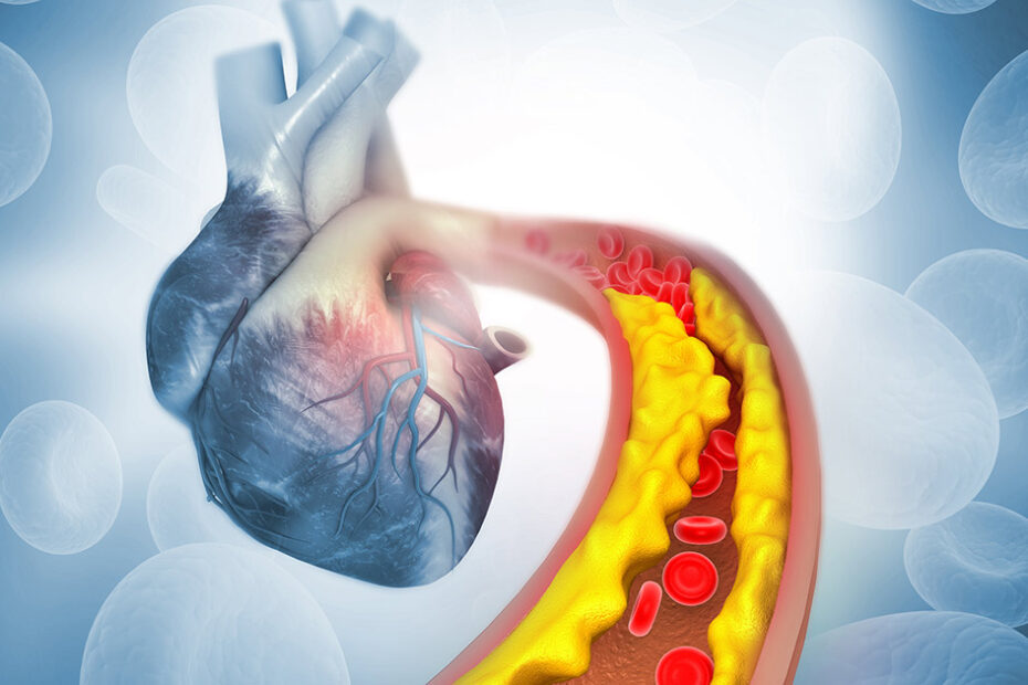 Environmental Factor - September 2024: Chelation therapy may reduce blood lead levels, but not heart attacks