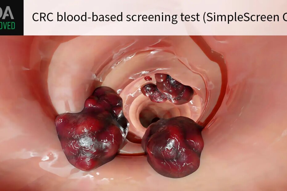 FDA APPROVED CRC blood-based screening test (SimpleScreen CRC) over a computer rendering of colorectal cancer.