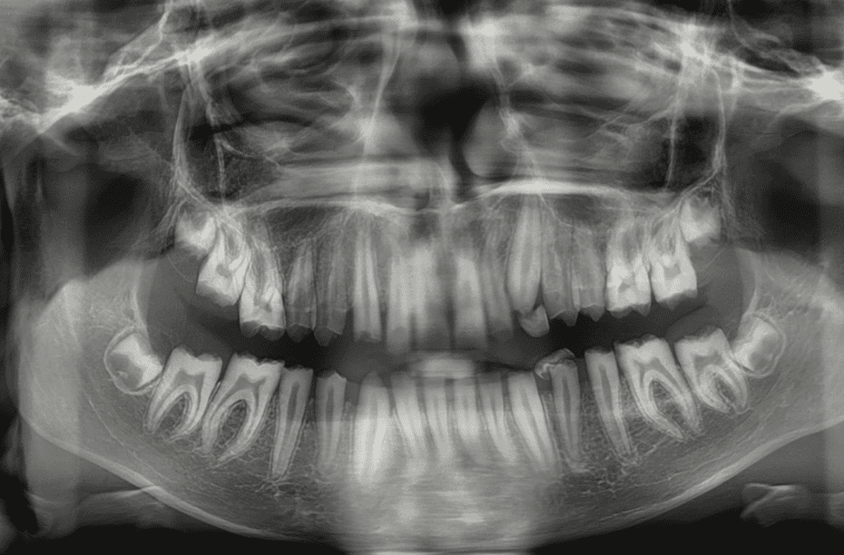 Full-Mouth Rehabilitation in an Adolescent With Amelogenesis Imperfecta