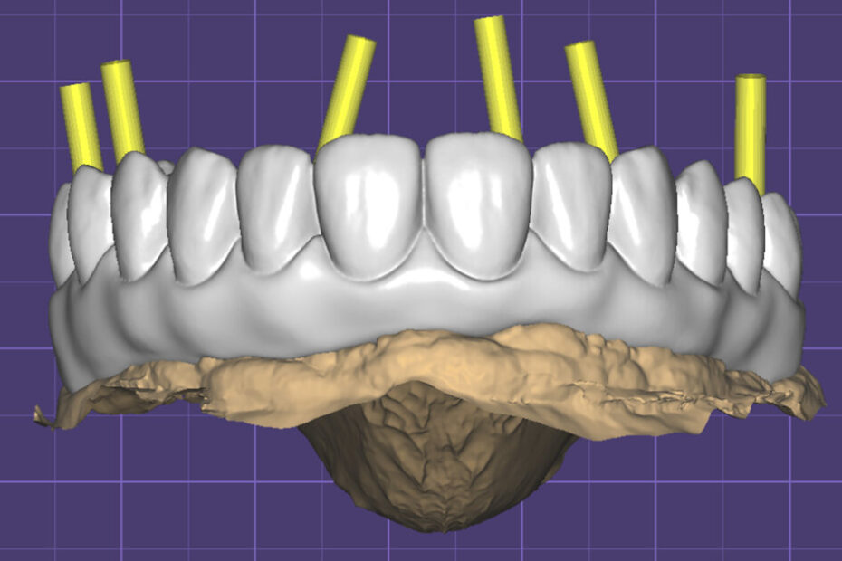 Hybrid implant-supported full-arch prosthesis production