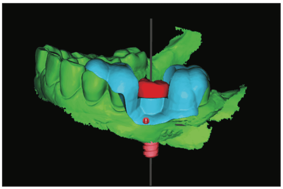 Implant Precision From Plan to Scan to Seat