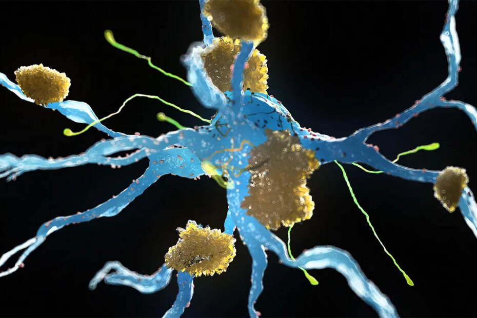 A computer rendering of amyloid plaques forming between neurons.