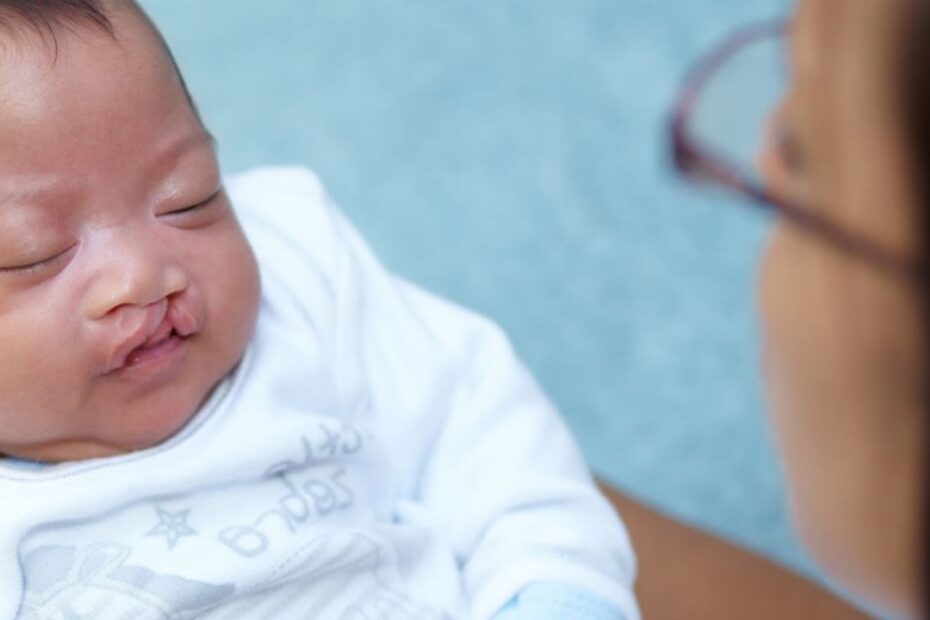 Oral Health for Children with Cleft Conditions
