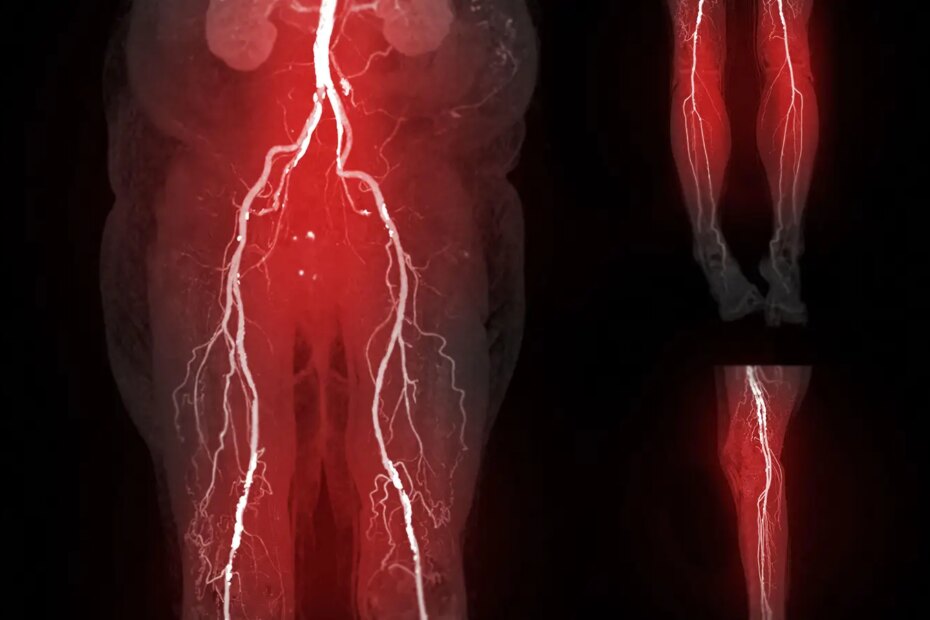Computed tomography angiography of a woman presenting with peripheral artery disease.
