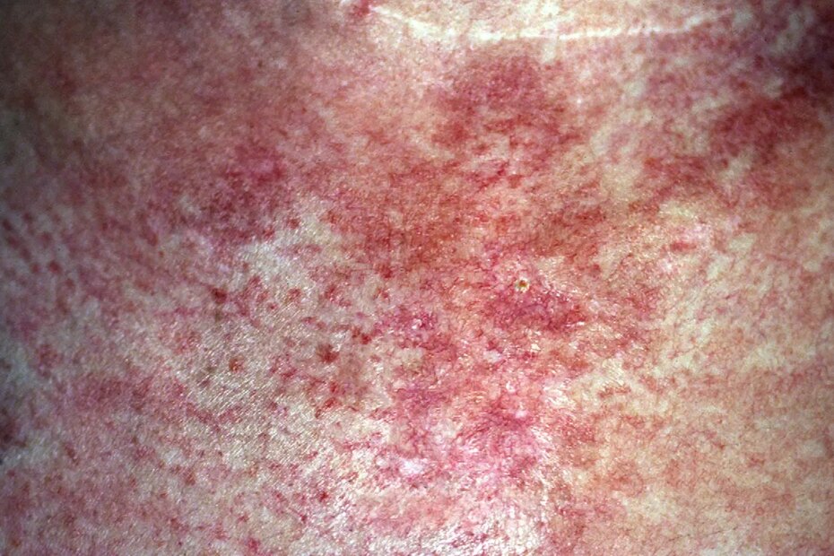 A photo of a dermatomyositis rash on a patient’s chest.