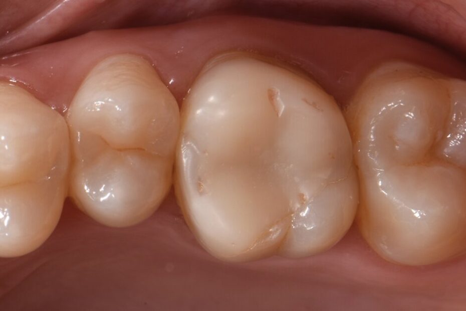 A biomimetic approach to restoration after endo treatment