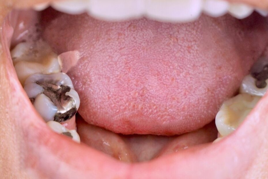 Action needed on dental amalgam phase-out in Southeast Asia