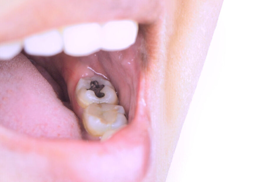 FDIWDC26 sessions on amalgam and determinants of oral health