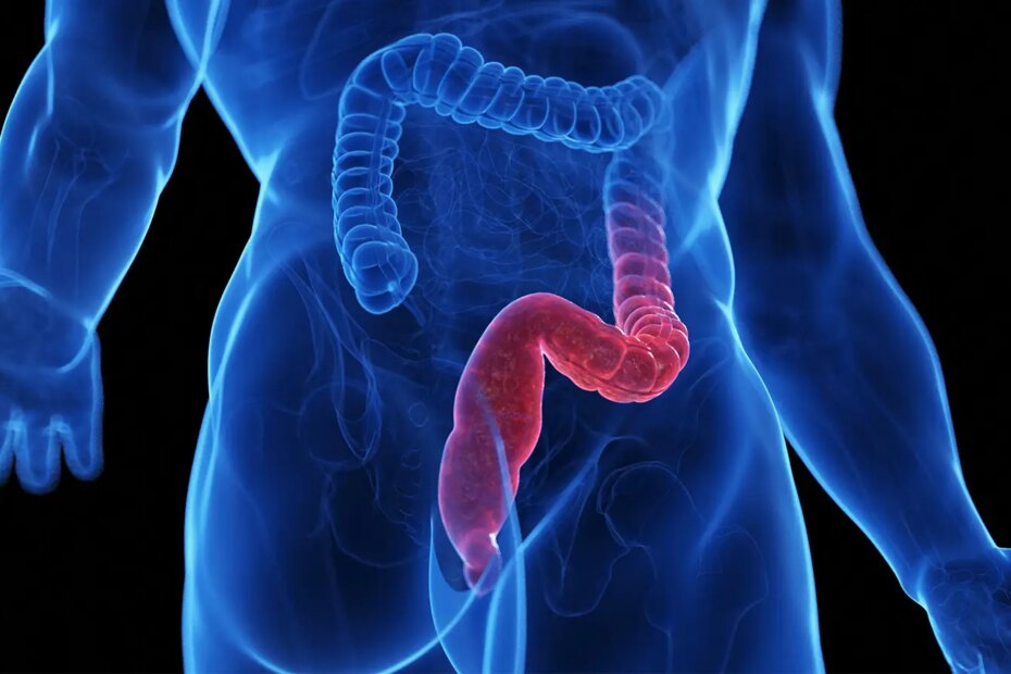 A computer rendering of ulcerative colitis.
