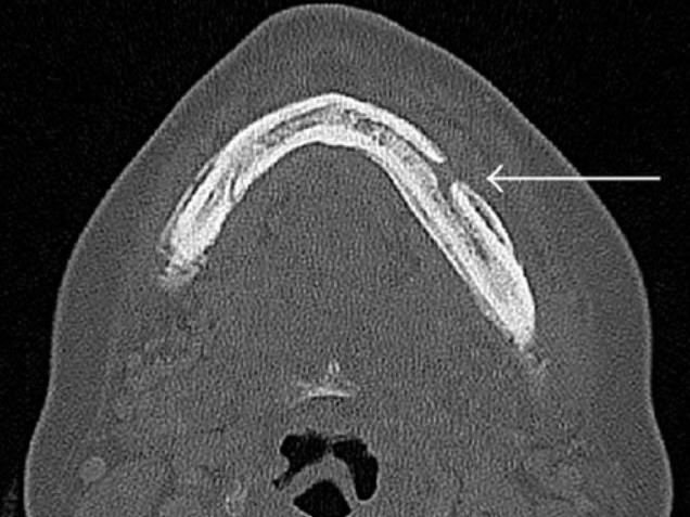How Common Is ONJ Caused by Bone-Modifying Drugs?