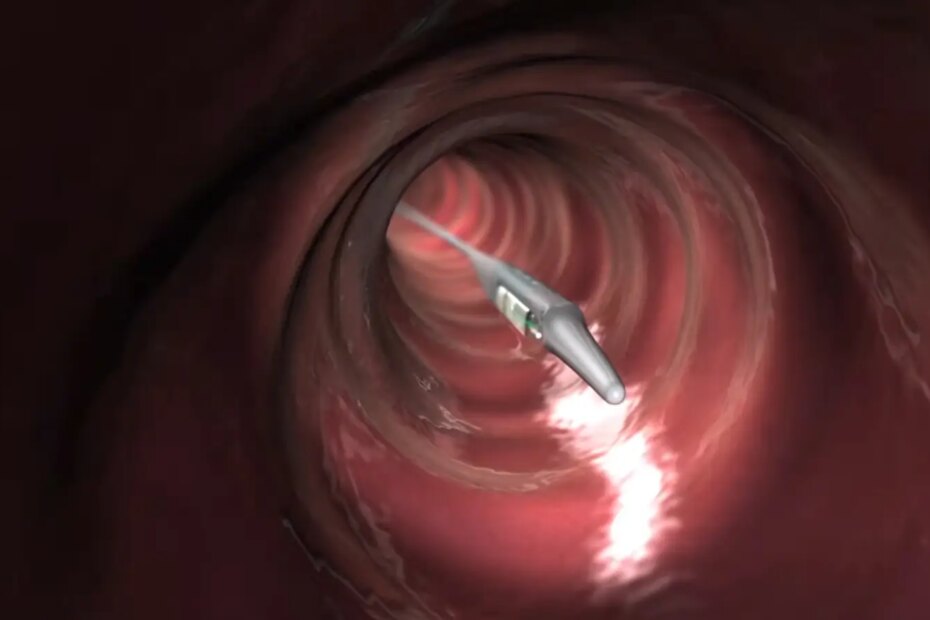 A computer rendering of the Bravo calibration-free acid-monitoring capsule inside an esophagus.