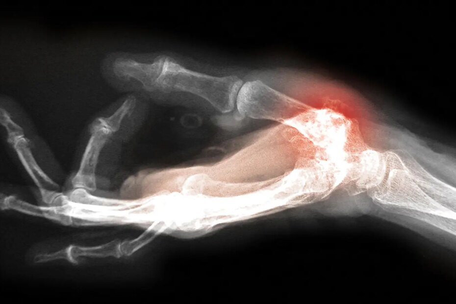 An x-ray image of a hand with arthritis at the first joint of the thumb.