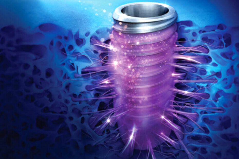 TS SOI gains ground in the European implant market