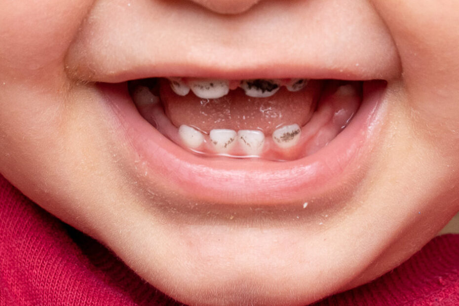Trial supports SDF for caries arrest in young children