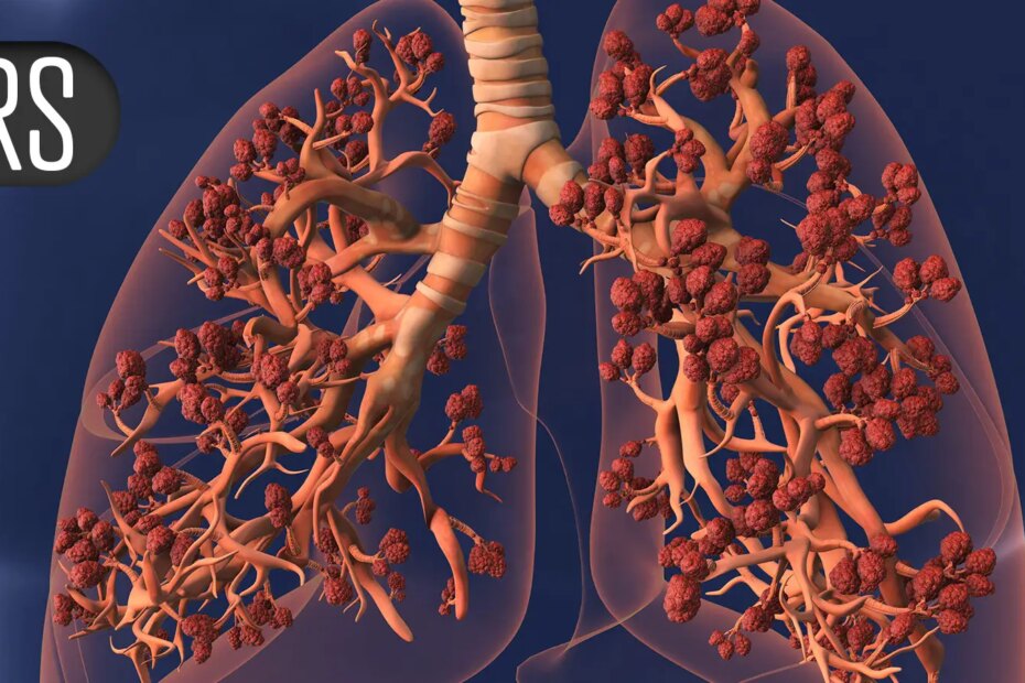 Asthma, COPD Attacks Down With GLP-1 Drugs in the Picture