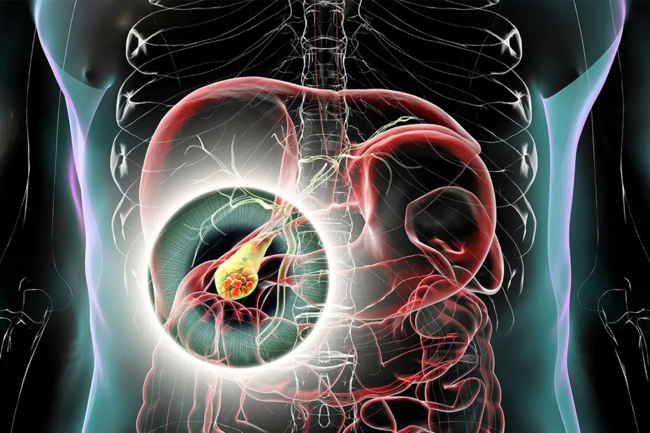 A computer rendering of a transparent body with the gallbladder and gallstones highlighted.