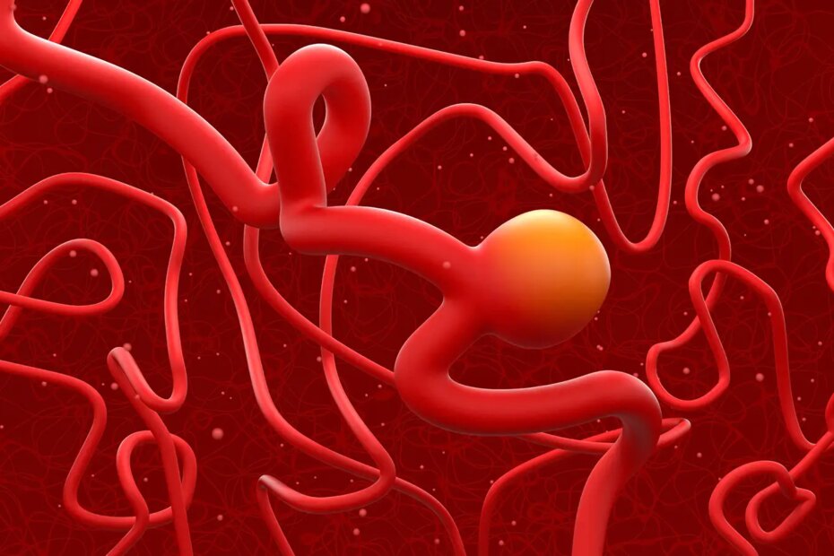A computer rendering of a cerebral aneurysm.
